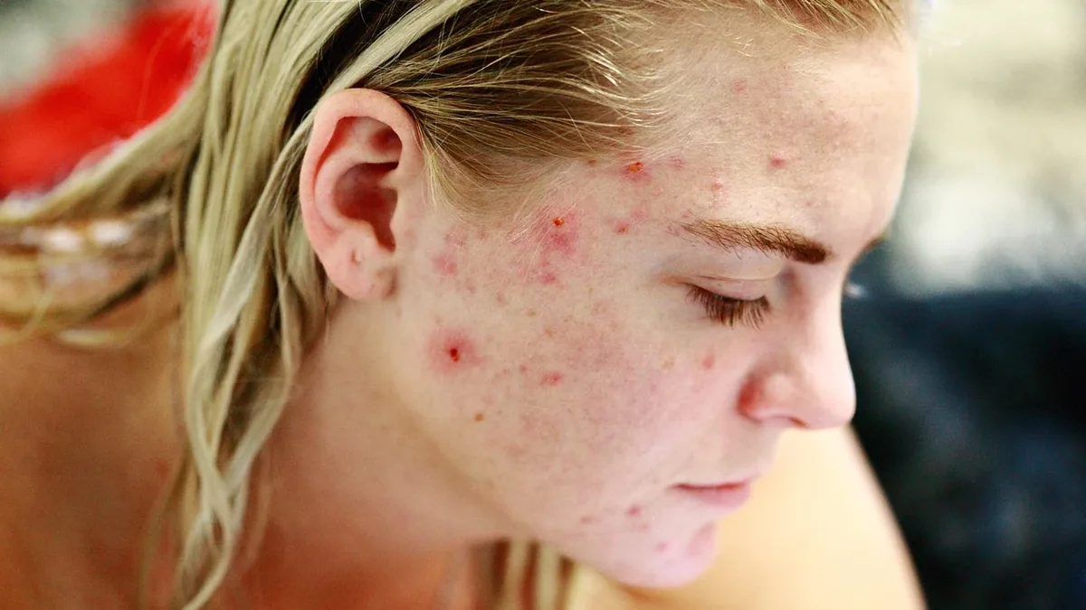 Acne Coverage