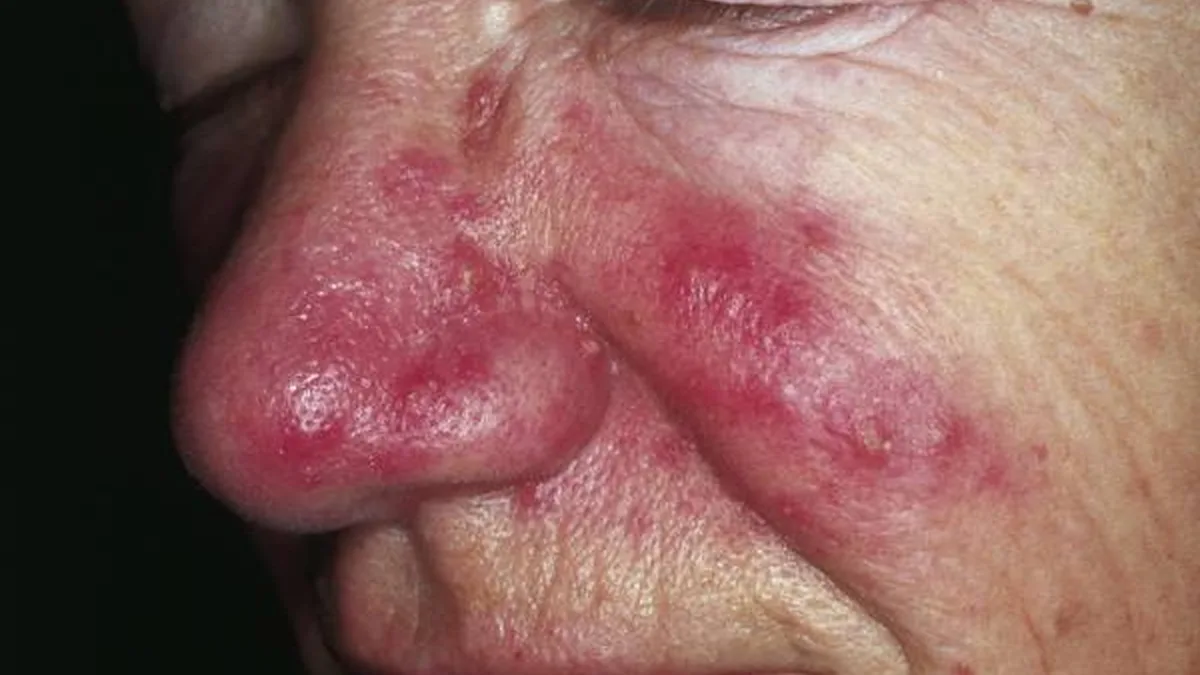 Redness And Rosacea
